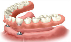 Illustration of an All-on-Two implant-supported denture being placed in the lower jaw by Premier Holistic Dental in beautiful Costa Rica.  The illustration shows how an All-on-Two is placed over 2 implants.