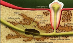 Illustration of a Cavitation treatment as done by Premier Holistic Dental in beautiful Costa Rica.  The illustration shows a cross section of a tooth and the supported nerve and roots.