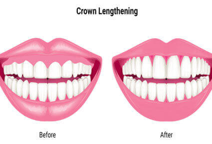 Illustration of a crown lengthening procedure done in Costa Rica.