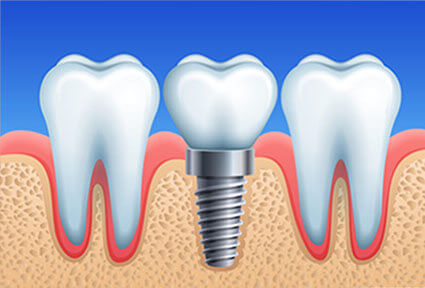 Illustration of a Holistic Dental Implant being placed in the lower jaw by Premier Holistic Dental in Costa Rica.