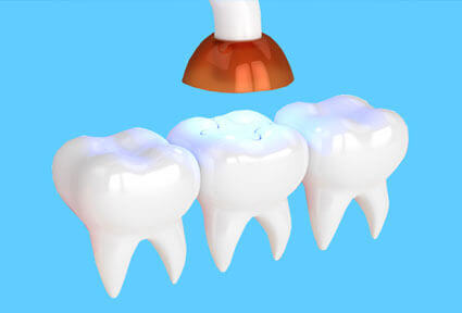 Illustration of a mercury-free/fluoride-free dental filling, showing how a tooth filling is done in Costa Rica.