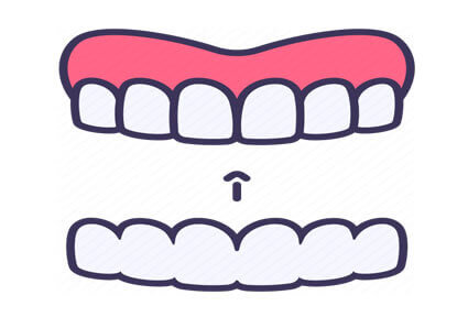 Illustration of a tooth in the lower jaw, showing how an invisalign orthodontics procedure is done in Costa Rica.