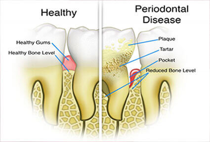 Illustration of three lower teeth showing how a periodontal procedure is done in Costa Rica
