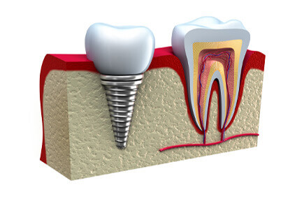 Illustration of a tooth in the lower jaw, showing how a prosthodontics procedure is done in Costa Rica.