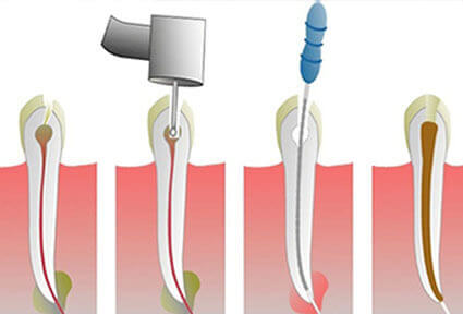 Illustration of a root canal procedure showing how the procedure is done in Costa Rica.