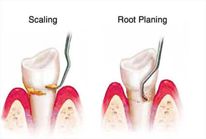 Illustration of a scaling/root-planing procedure done in Costa Rica.