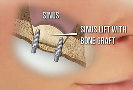 Illustration of a sinus lift procedure done in Costa Rica.