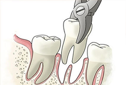 Illustration of the lower teeth showing how a dental extractions procedure is done in Costa Rica