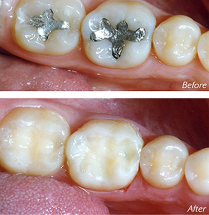Picture of a metal fillings in two teeth, which are removed and replaced with holistic fillings, as performed by the world famous Premier Holistic Dental in San Jose, Costa Rica.
