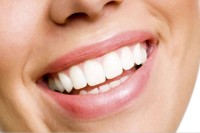 Close-up picture of a smiling woman, happy with the full mouth makeover she had in Costa Rica.