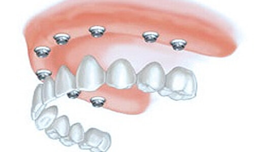 Illustration of an all-on-eight implant-supported denture as made at Premier Holistic Dental in beautiful Costa Rica.  The illustration shows how the denture is attached to the implants.