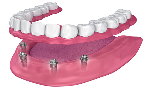 Illustration of an all-on-four implant-supported denture made at Premier Holistic Dental in beautiful Costa Rica.  The illustration shows how the denture is attached to the implants.
