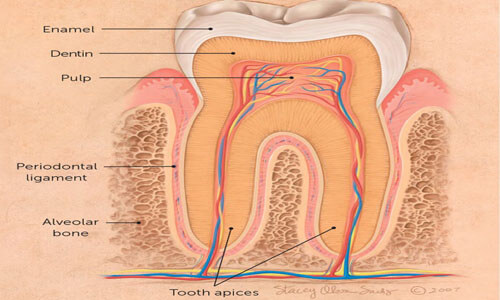 Illustration of a dental Cavitation procedure as done at at Premier Holistic Dental in beautiful Costa Rica.  The illustration shows a cross section of a tooth and where a cavitation can occur.