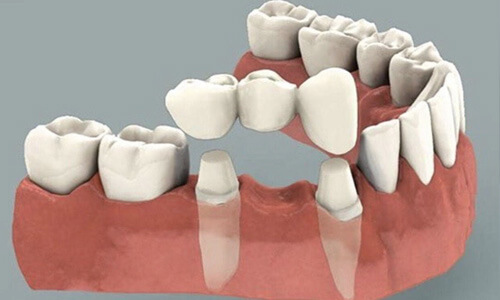 Illustration of a dental bridge showing how it is placed on adjoining teeth at Premier Holistic Dental in beautiful Costa Rica.  The teeth are white and the illustration shows a 3 unit bridge being placed on  the lower teeth.