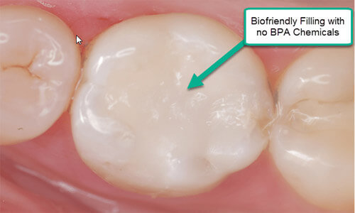 Illustration of a Holistic dental bonding as done at Premier Holistic Dental in beautiful Costa Rica using no BPA chemicals.   The illustration shows 3 lower teeth with the filling material applied to the center of the middle tooth.
