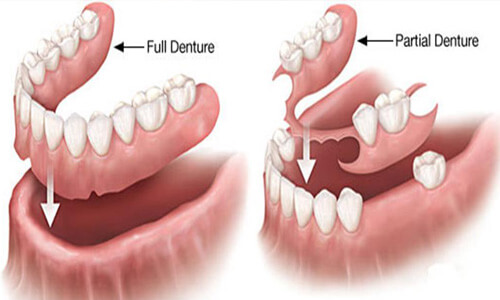 Illustration of a Holistic denture as made at Premier Holistic Dental in beautiful Costa Rica.  The illustration shows how a full denture or a partial denture fits into place in the mouth.