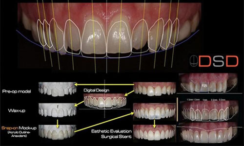Illustration of a Digital Smile Design (DSD) computer screen showing a dental design as offered by Premier Holistic Dental in beautiful Costa Rica.  The illustration shows several angles of teeth design.
