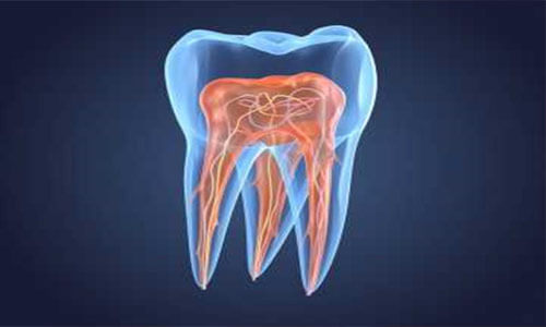 Illustration of a tooth showing an Endodontics procedure as done at Premier Holistic Dental in beautiful Costa Rica.  The illustration shows the inner structure and roots of a tooth.