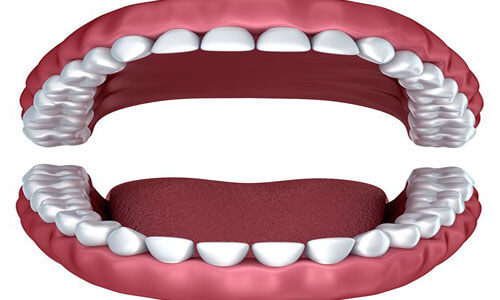 Illustration of a dental full mouth makeover as done at Premier Holistic Dental in beautiful Costa Rica.  The illustration shows an open mouth will all of the teeth on both the upper and lower arches visible.