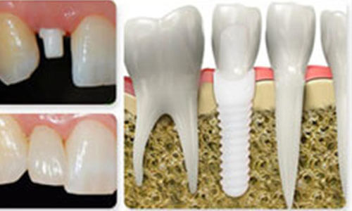 Illustration of a white ceramic holistic dental implant and zirconia crown as prepared by Premier Holistic Dental in beautiful Costa Rica.  The illustration shows how the crown is attached to the implant.