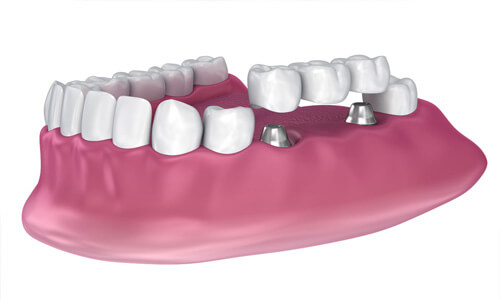 Illustration of an implant supported bridge as made at Premier Holistic Dental in beautiful Costa Rica.  The illustration shows the lower teeth with a 3 unit bridge being attached to two implants.