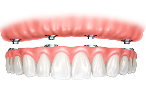 Illustration of an implant supported denture as made at Premier Holistic Dental in beautiful Costa Rica.  The illustration shows the upper denture being attached with four implants