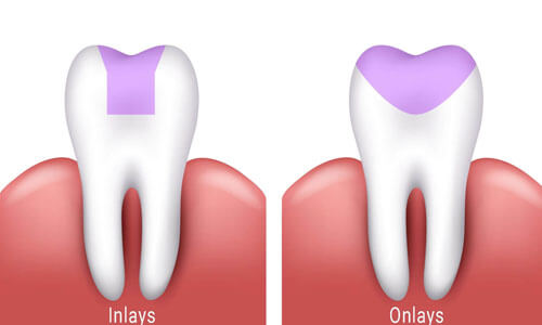 Illustration of a front chipped tooth repaired with dental bonding as done at at Premier Holistic Dental in beautiful Costa Rica.  The illustration shows the upper and lower teeth and how a bonding procedure is done.