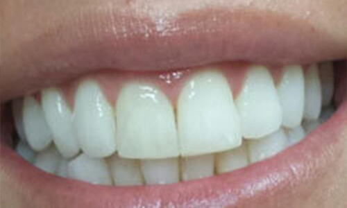 Close-up picture of a smiling woman with perfect white, and aligned, teeth, showing her happiness with the Invisalign procedure she had done at Premier Holistic Dental in beautiful Costa Rica.