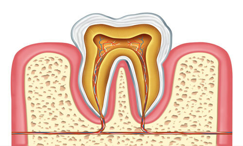 Illustration of a tooth showing an Endodontics procedure as performed by Premier Holistic Dental in beautiful Costa Rica.  The illustration shows the inner structure and roots of a tooth.