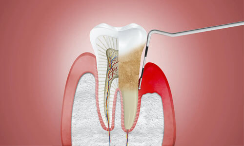 Illustration of a tooth with needing periodontics work., and how the procedure is done at Premier Holistic Dental in beautiful Costa Rica. The illustration shows a dental tool being used to remove periodontal disease.