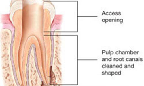 Illustration of a dental root canal procedure.  The illustration shows a cross-section of a tooth with a dental utensil removing infections through a root canal.