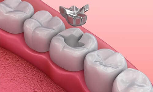 Illustration of a dental tooth depicting a safe mercury removal procedure as done at Premier Holistic Dental in beautiful Costa Rica.  The illustration shows 5 lower teeth with the old mercury filling being removed from the middle tooth.