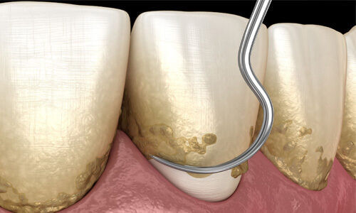 Illustration of a 3 teeth needing a scaling and root planing procedure in Costa Rica. The illustration shows how the lower part of the tooth is scraped to remove plaque.