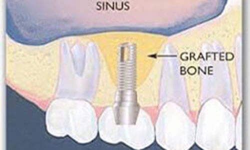 Illustration of a dental sinus lift procedure as done by Premier Holistic Dental in beautiful Costa Rica.  The illustration shows the sinus area above the upper teeth where the dental procedure will be done to support dental implants.