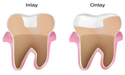 Illustration of an dental inlay and onlay as it is performed in the lower jaw at Premier Holistic Dental in beautiful Costa Rica.  The picture shows two different teeth with an inay one and an onlay on the other