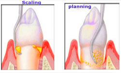 Illustration of a scaling and root planing procedure being done in the lower jaw at Premier Holistic Dental in beautiful Costa Rica.  The illustration shows scaling on the left and planing on the right.