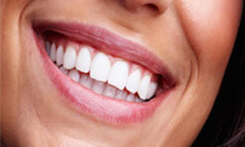 Close-up picture of a smiling young woman, showing perfect white teeth, and happy with her Holistic sinus lift treatment at Premier Holistic Dental in beautiful Costa Rica.