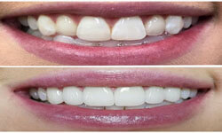 Close-up picture of a smiling woman showing her dental veneers procedure she had at Premier Holistic Dental in beautiful Costa Rica. The picture shows before and after the veneers procedure.